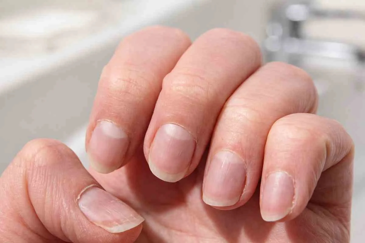 Co paznokcie mówią o Twoim zdrowiu. Niektóre zmiany mogą być sygnałem raka.